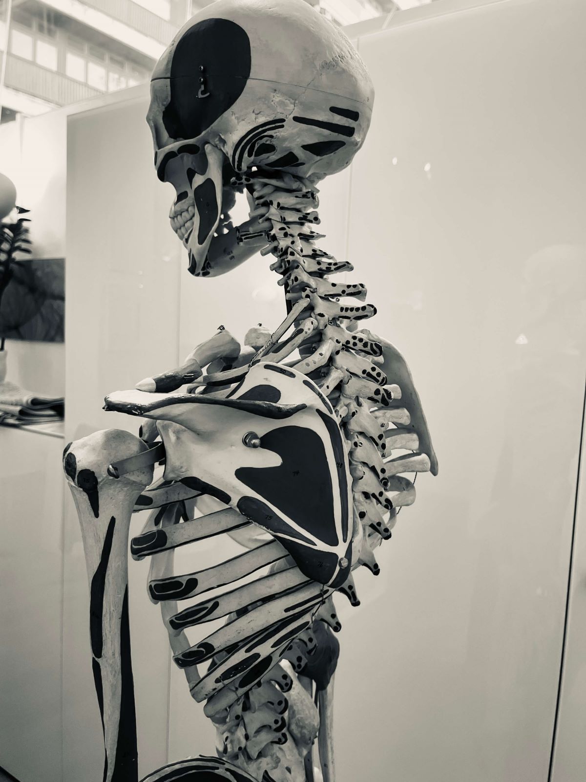 Osteopathy for Back Pain and Paresthesia: A Key Tool in My Recovery from Tarlov Cysts